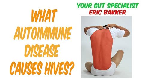 What Autoimmune Disease Cause Hives