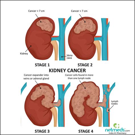 What Cause Kidney Tumor