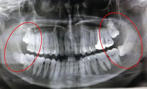 What Causes Dentigerous Cyst