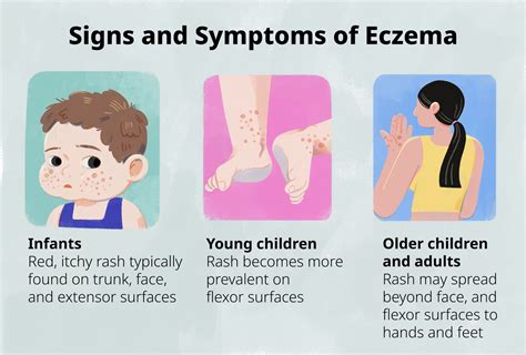 What Causes Severe Eczema In Babies