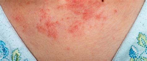 What Causes Sudden Eczema Outbreak